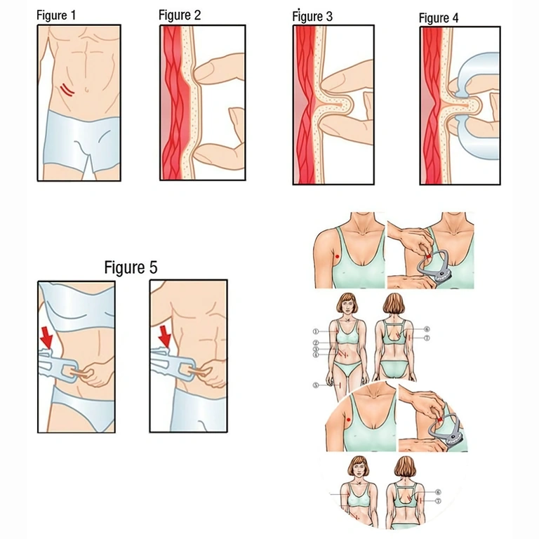 Príklad použitia plicometra Ako používať plicometer na meranie kožných záhybov